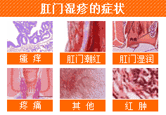 肛门湿疹